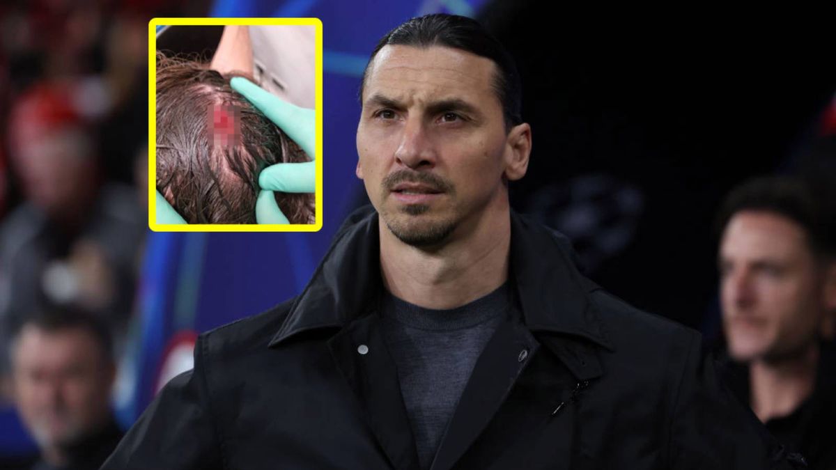 Getty Images / Claudio Villa / Zlatan Ibrahimović/Instagram / Zlatan Ibrahimović i jego rana na głowie