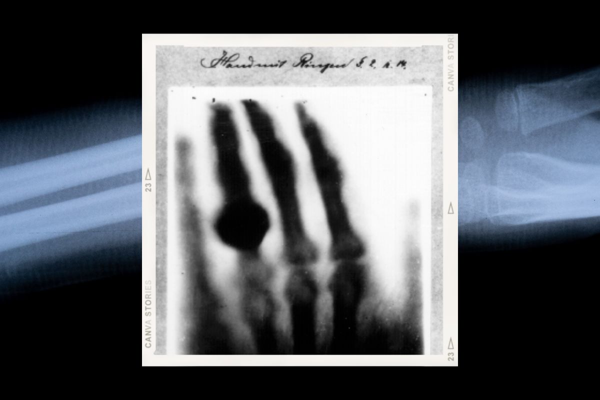 Pierwsze zdjęcie rentgenowskie w historii