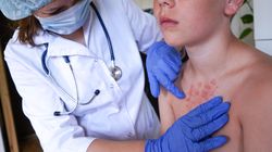 Rośnie liczba zachorowań na ospę wietrzną. Eksperci alarmują i przypominają o szczepieniach