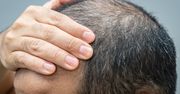 Polscy mężczyźni szybko tracą włosy. Są w pierwszej dziesiątce najbardziej łysiejących narodów