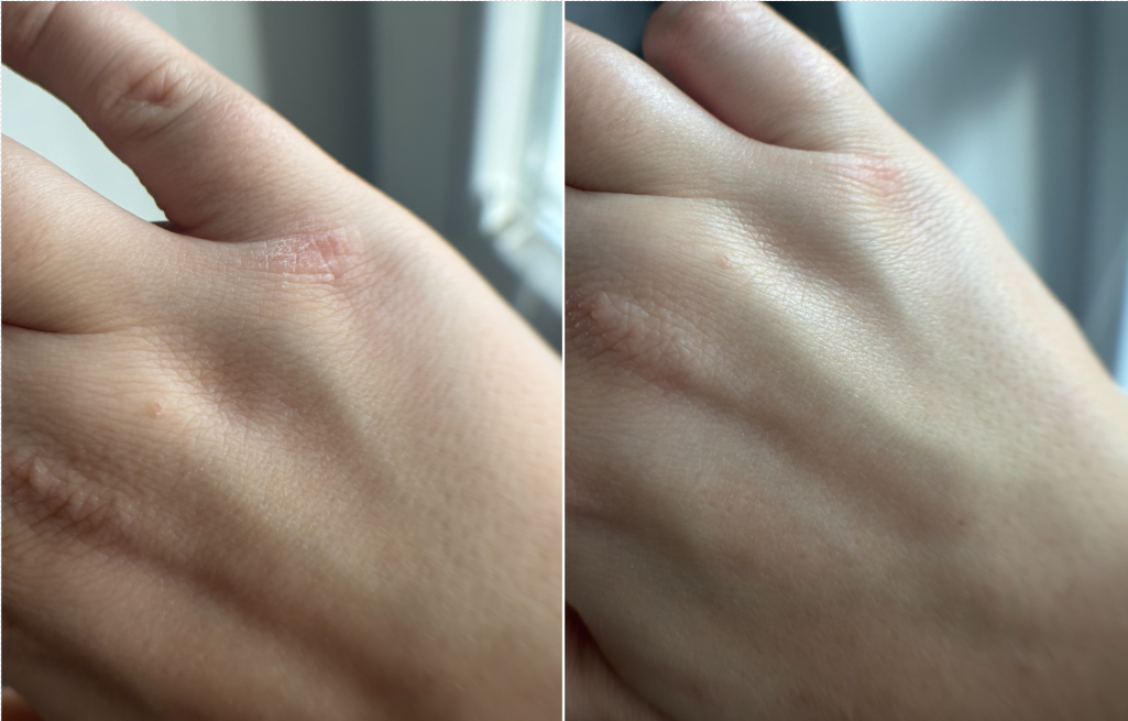 Test serii Lipikar od La Roche-Posay na drobnej zmianie atopowej