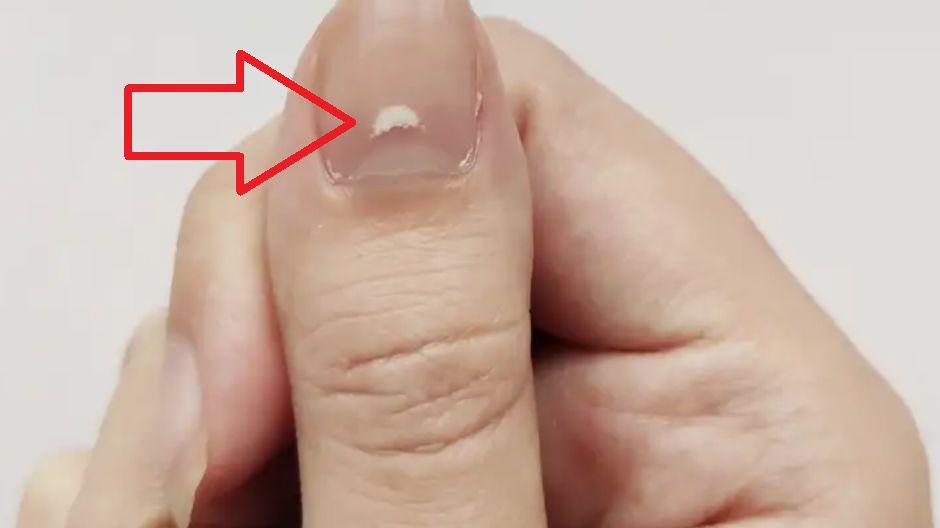 Białe plamy to nie zawsze objaw uszkodzenia paznokcia