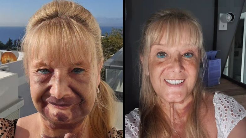 Jej zęby były w ruinie. Wyrwała te, co zostały i wstawiła tureck