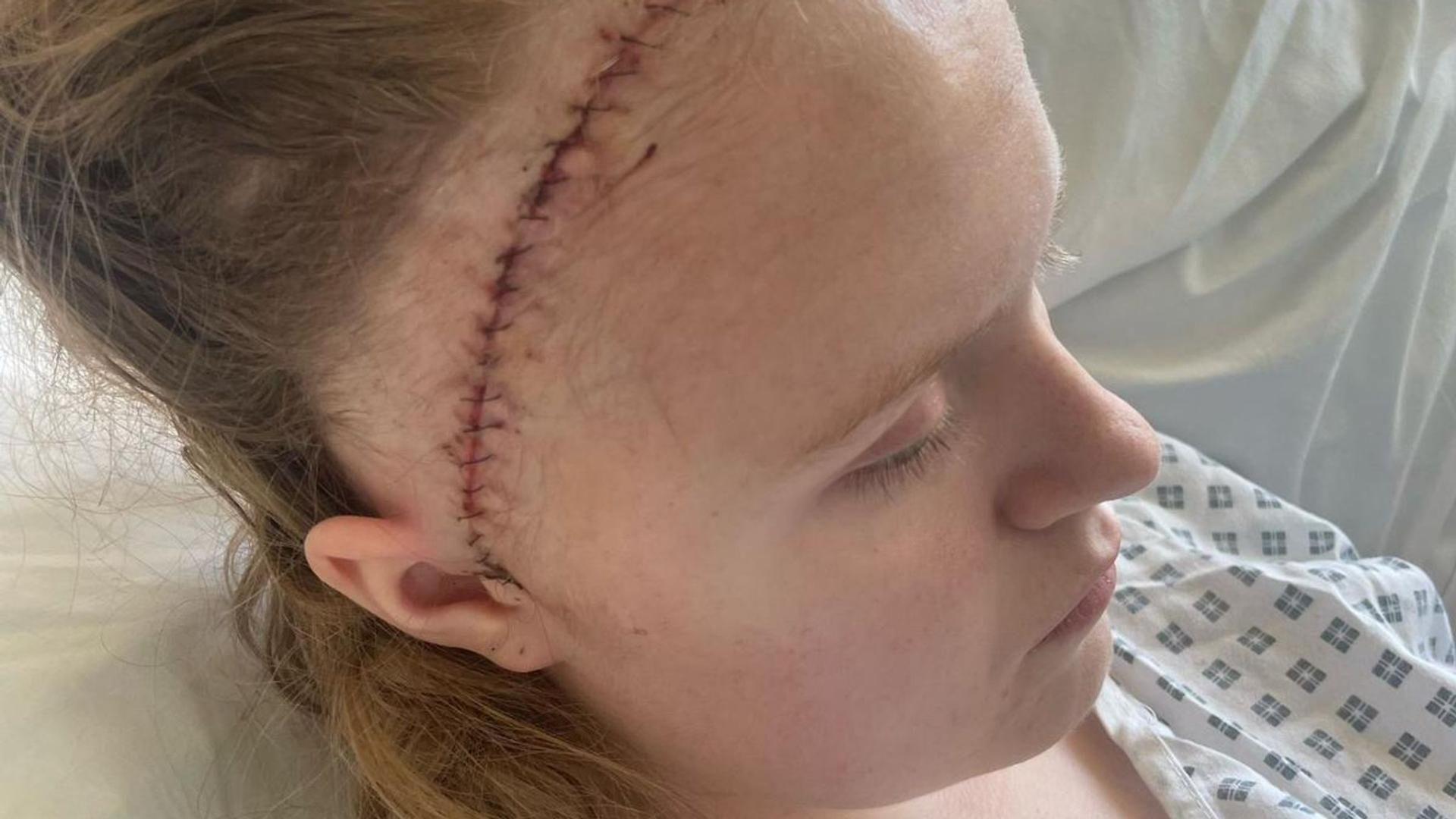 Ellie miała naczyniaka jamistego 