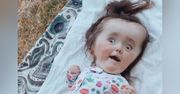 Miała nie dożyć pierwszych urodzin. Tak teraz wygląda mała Luna