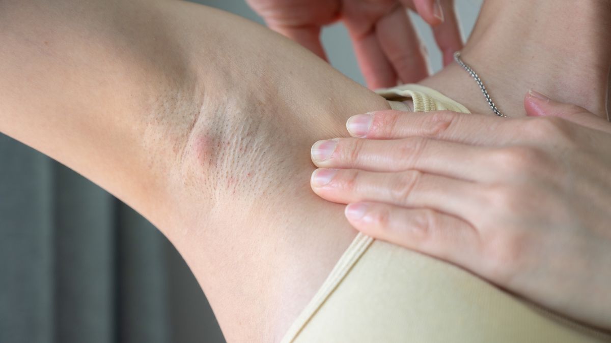 Jakie objawy daje rak piersi?