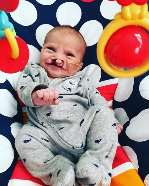 Mały Brody urodził się z silną deformacją, ale dzięki operacji może żyć normalnie