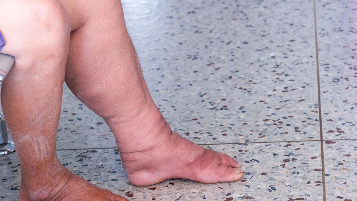 W wyjątkowych przypadkach chorych z obrzękiem limfatycznym można operować