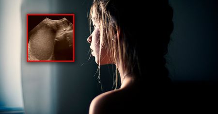 14-latka nie miała miesiączki. Rzadka anomalia anatomiczna
