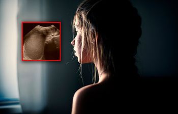 14-latka nie miała miesiączki. Rzadka anomalia anatomiczna