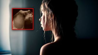 14-latka nie miała miesiączki. Rzadka anomalia anatomiczna