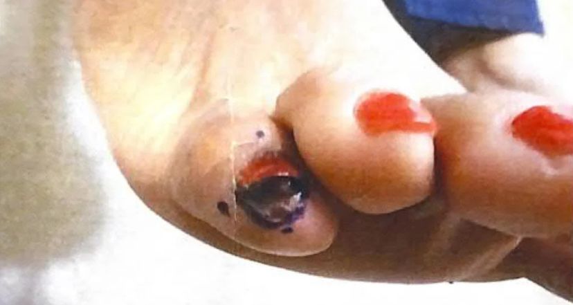 By powstrzymać chorobę, trzeba było dokonać amputacji palca