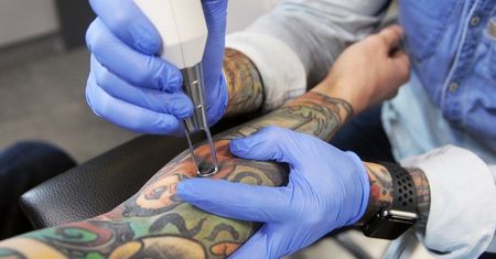 Tatuaż nie musi być na całe życie. Ale usunięcie potrafi być droższe i bardziej bolesne niż zrobienie