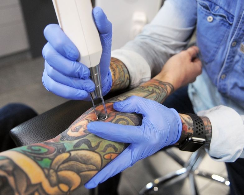 Usuwanie tatuażu to długotrwały, niezbyt przyjemny i kosztowny proces