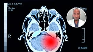 Typowy objaw guza mózgu. Neurochirurg: Nigdy nie powinien być ignorowany
