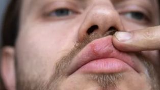 Czym są plamki Fordyce'a? Subtelny objaw wysokiego cholesterolu