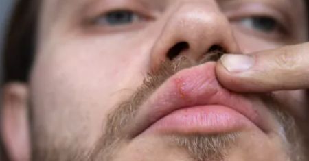 Czym są plamki Fordyce'a? Subtelny objaw wysokiego cholesterolu