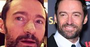 Hugh Jackman po raz PIĄTY usunął zmianę nowotworową z nosa!