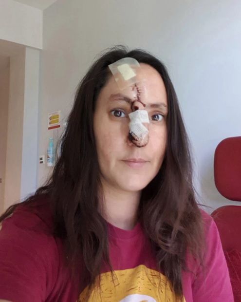 Kobieta straciła część nosa i potrzebowała przeszczepu skóry