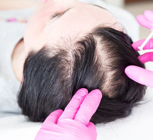 Hormony tarczycy nie pozostają także bez wpływu na stan włosów, a ich nieprawidłowy poziom może skutkować łysieniem.