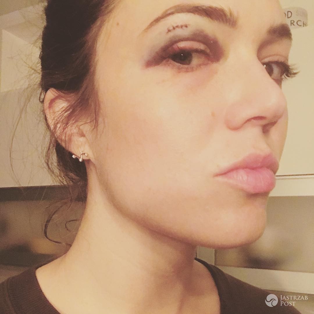 Mandy Moore miała nieszczęśliwy wypadek