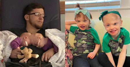 Były zrośnięte czaszkami i miały DWA PROCENT szans na przeżycie. Dziś Eric i Abby skończyły przedszkole: "To jest jak sen" (FOTO)