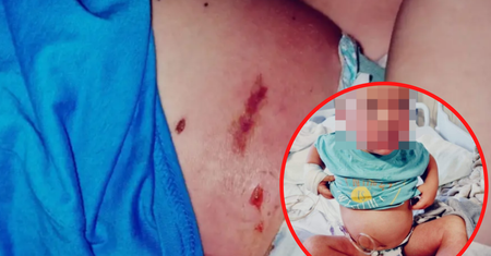 Podczas ospy wietrznej podała dziecku popularny lek. Jej synek niemal zmarł