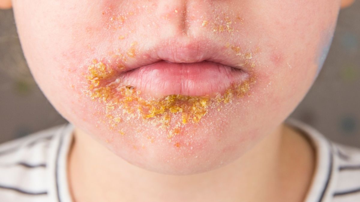 Liszajec to choroba bakteryjna skóry wywołana przez gronkowce lub paciorkowce.