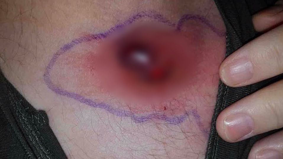 Mężczyzna dostał sepsy po obgryzaniu paznokci