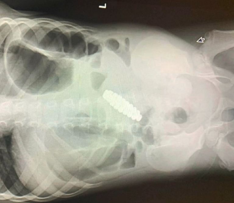 W brzuchu chłopca znajdowała się bransoletka