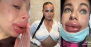 Influencerka powiększyła usta w barterze. Po zabiegu omal nie EKSPLODOWAŁY: "Najgorszy dzień w moim życiu" (FOTO)