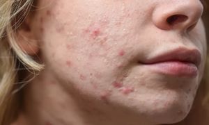 Wiele osób zmienia ją za rzadko. Wtedy pojawiają się wypryski