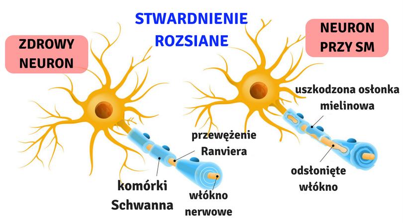 Stwardnienie rozsiane