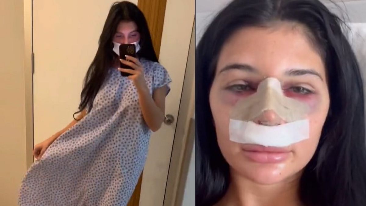 Zrobiła korektę nosa w Turcji. 