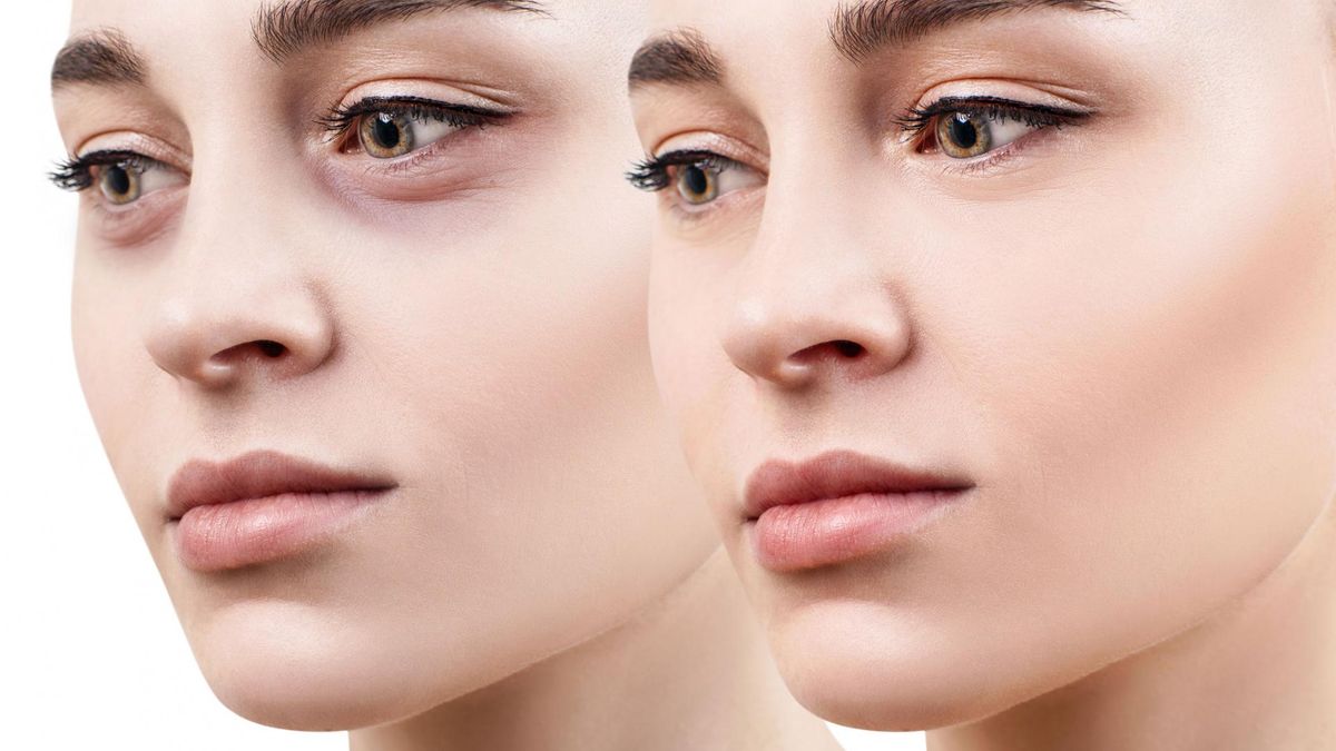 Podkrążone oczy są mankamentem urody, który pojawia się z różnych przyczyn, nie tylko z powodu przemęczenia, niewyspania czy przepracowania.