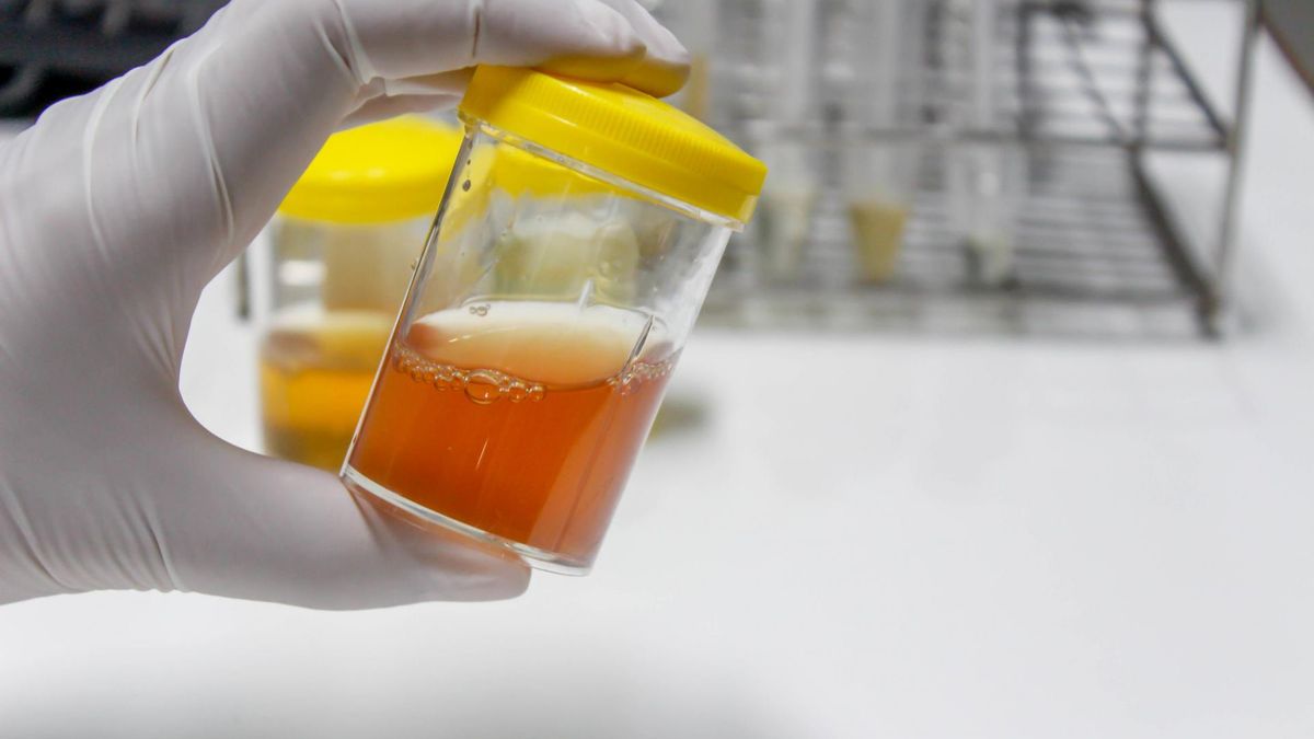 Albuminuria jest objawem chorobowym, którego istotą jest występowanie drobnocząsteczkowych albumin w moczu.