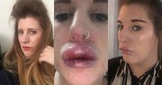 Chciała powiększyć usta. Teraz nie może na siebie patrzeć