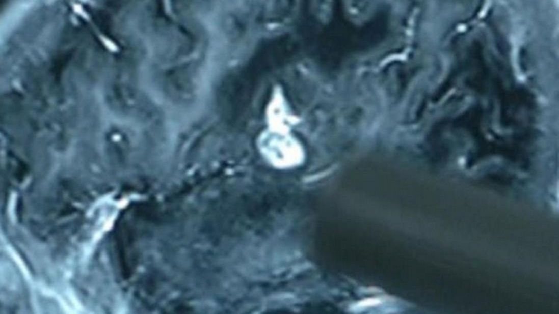 Przerażająca historia. Miał tasiemca w głowie