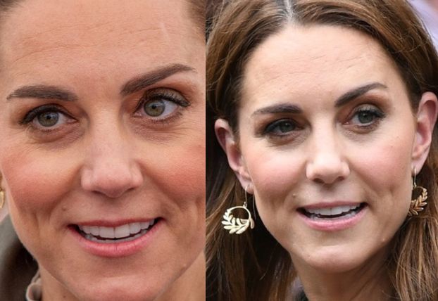 Kate Middleton wstrzykuje sobie botoks? Pałac Kensington skomentował doniesienia kliniki