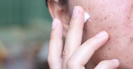 Krem na trądzik – który dobry, a jaki nieodpowiedni?