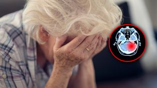 Szansa w leczeniu glejaka? Naukowcy użyli wirusa opryszczki