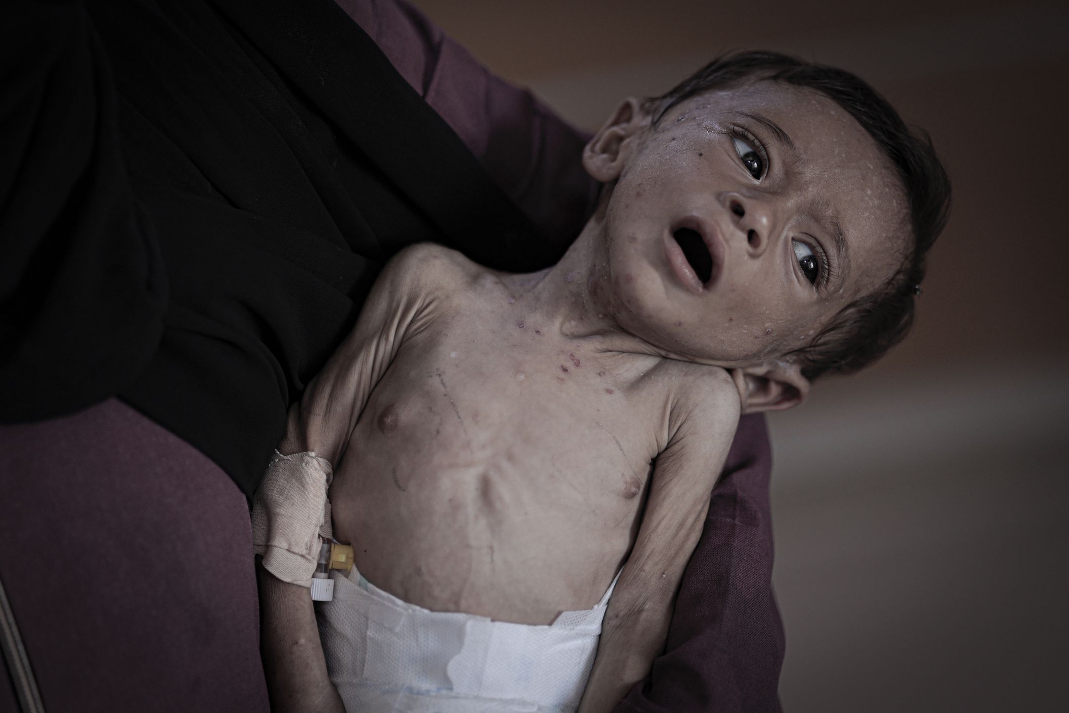 Życie tego dziecka w Gazie jest zagrożone 