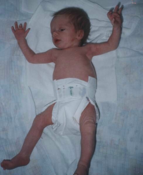 Mateusz urodził się z Zespołem Silver-Russel