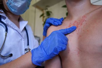 Odra oficjalnie powróciła w sześciu krajach. WHO ostrzega