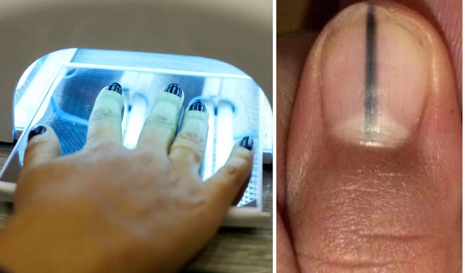 Nadmierna ekspozycja na promieniowanie UV może sprzyjać rozwojowi czerniaka pod paznokciem