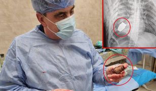 Niezwykła operacja w Ukrainie. To wyjęli z ciała rannego żołnierza
