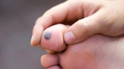 Nietypowy objaw wysokiego cholesterolu we krwi. Zmiana na palcu stopy