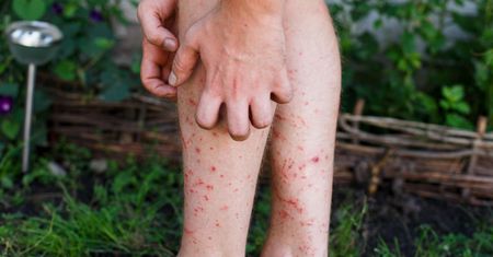 Krostki na skórze mogą zwiastować problemy z jelitami. Nie ignoruj