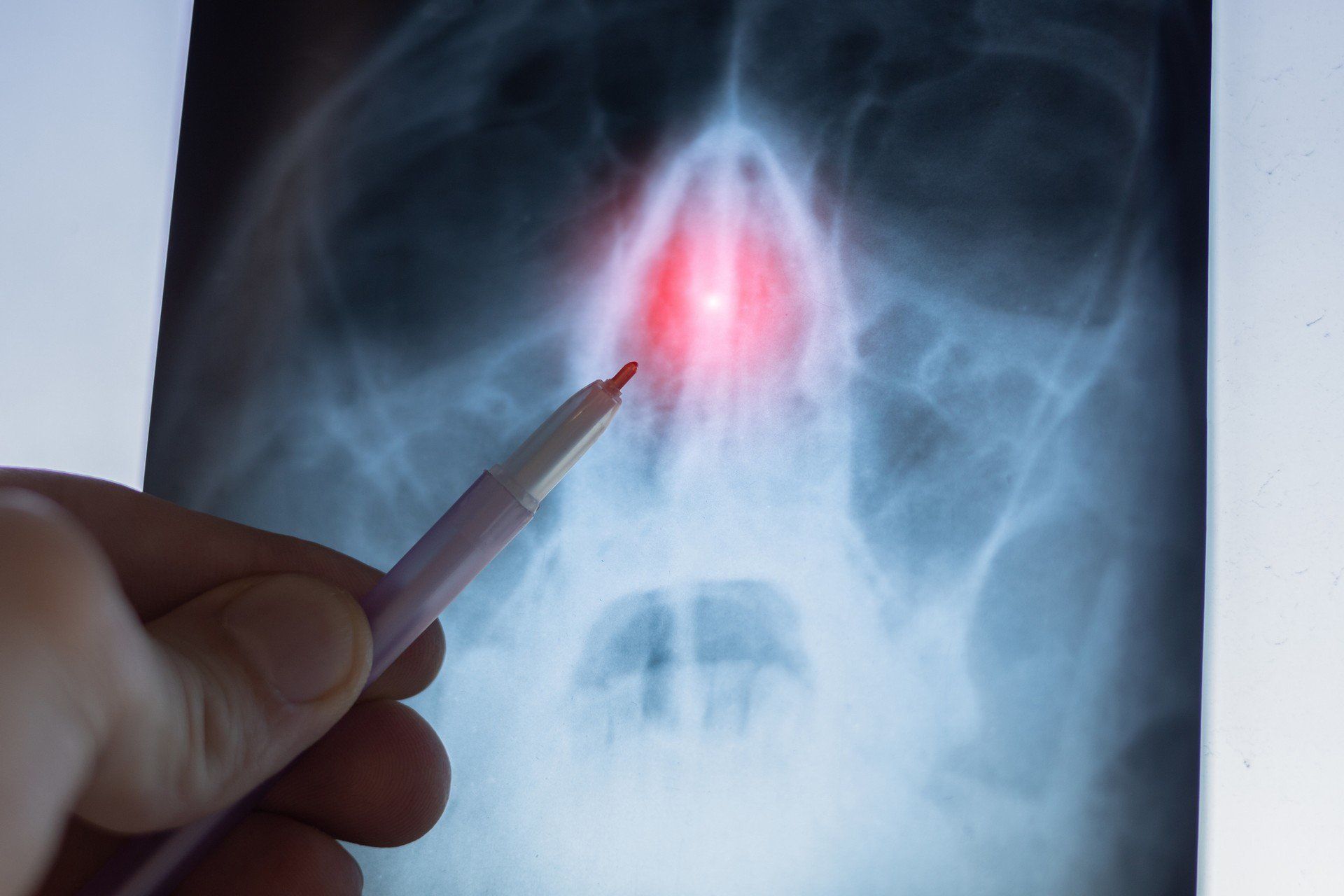 Czy prostowanie przegrody nosa naprawdę jest bolesne? Czy to prawda, że zmienia się po tym wygląd nosa i zostają blizny? W którym szpitalu prostują najlepiej? Przeszedłem prostowanie i opowiadam, jak było.