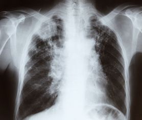 Spirometria nie boli, a ratuje życie